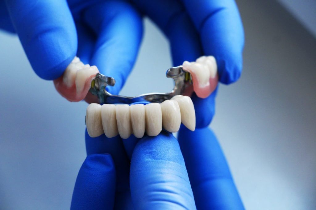 What Is A Dental Bridge?