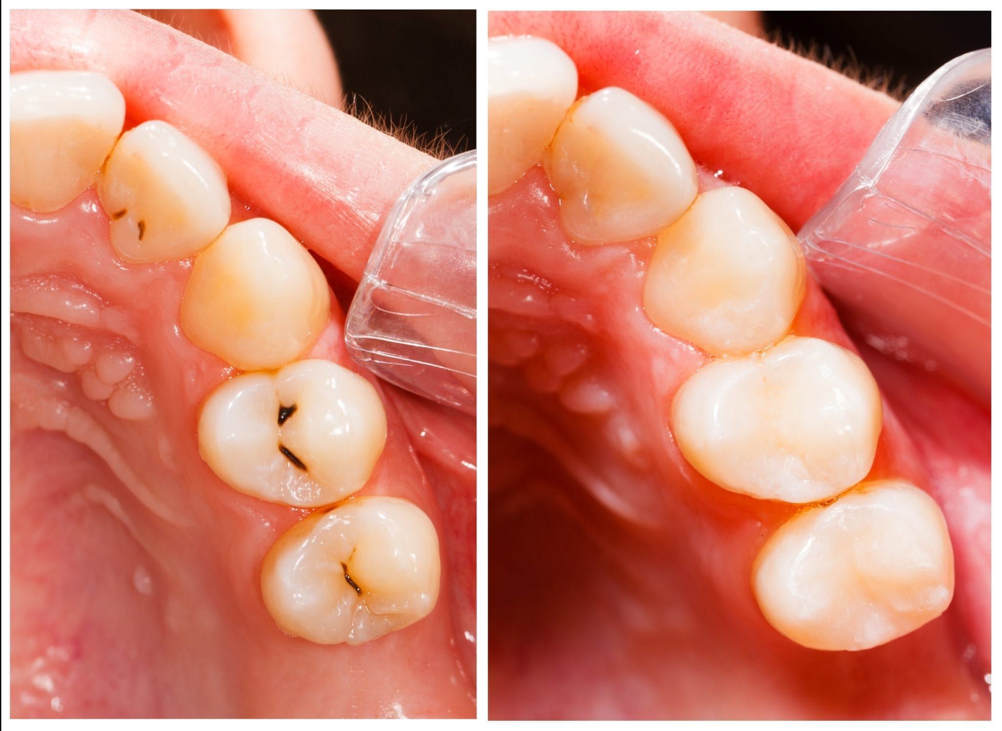 What Is A Composite Filling? Appletree DentistryTigard, OR