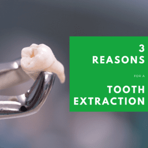 3 Reasons for a Tooth Extraction