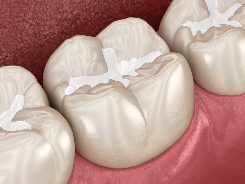 Dental sealant on molars
